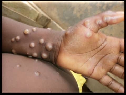 RDC : 271 décès sur 3941 cas de l’épidémie de Monkeypox recensés en 2024